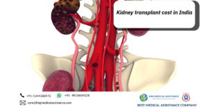 kidney transplant cost in India